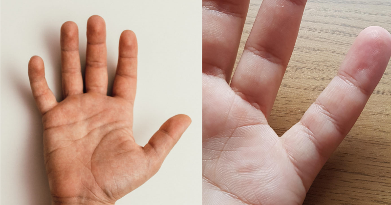 Did you know that only a few people have an extra crease on their little finger?